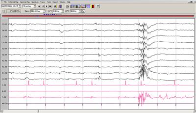 EEG Patterns Orienting to Lafora Disease Diagnosis—A Case Report in Two Beagles